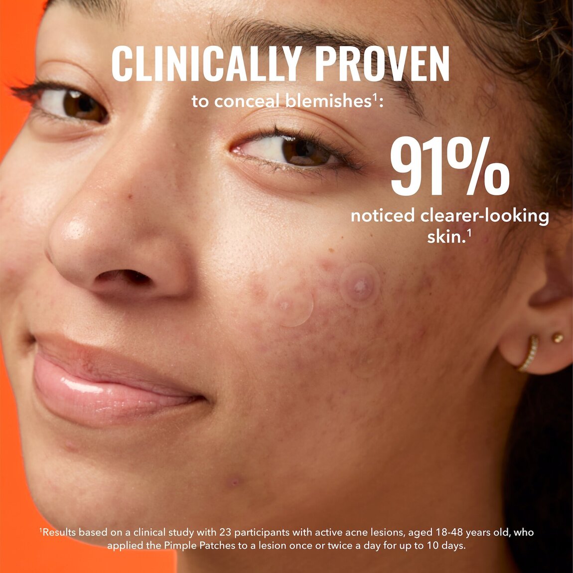 pimple-patches-e1 zb_p.jpg