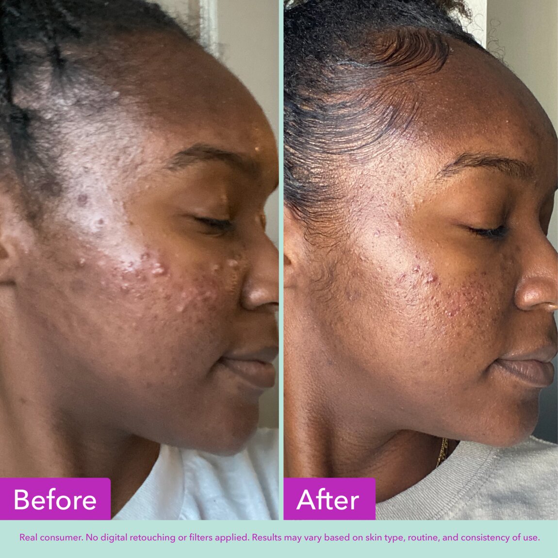 acne-foaming-cleanser-h7 zb_p.jpg